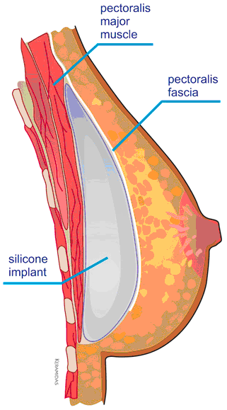subfascial